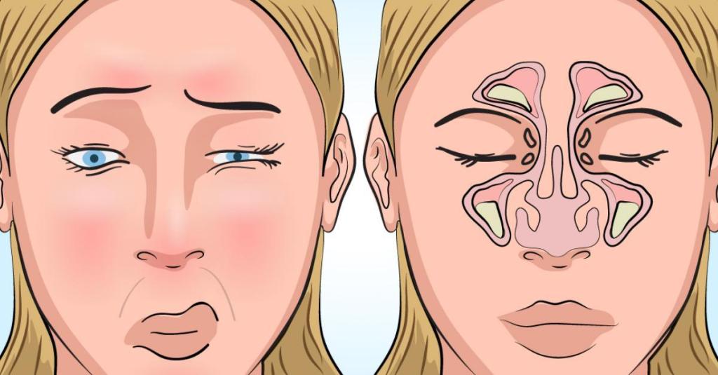 Zwei Illustrationen einer blonden Person, die ihr Gesicht verzieht. Rechts sieht man die Nasennebenhöhlen darauf retuschiert.