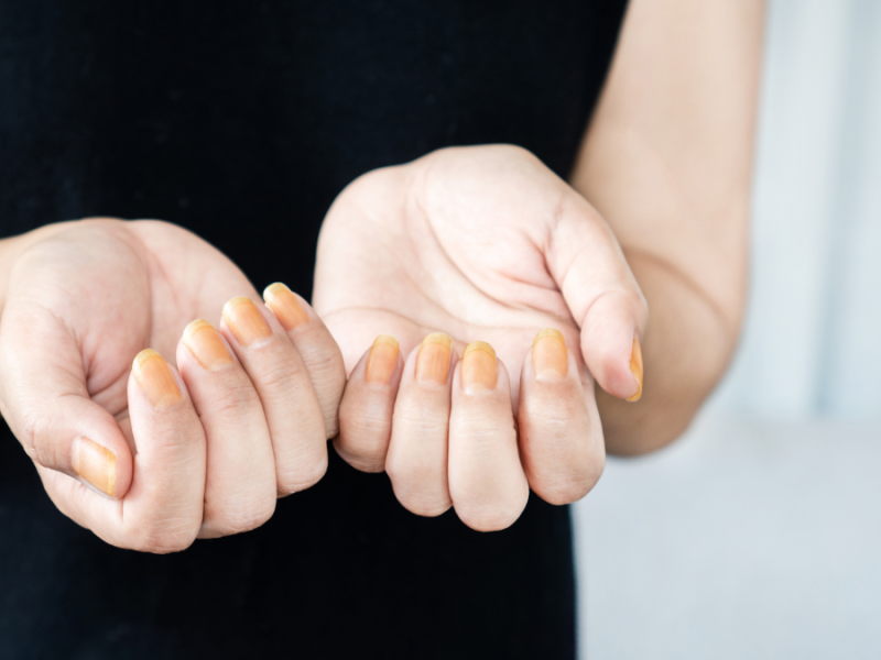 Eine Frau schaut sich ihre verfärbten Fingernägel an.