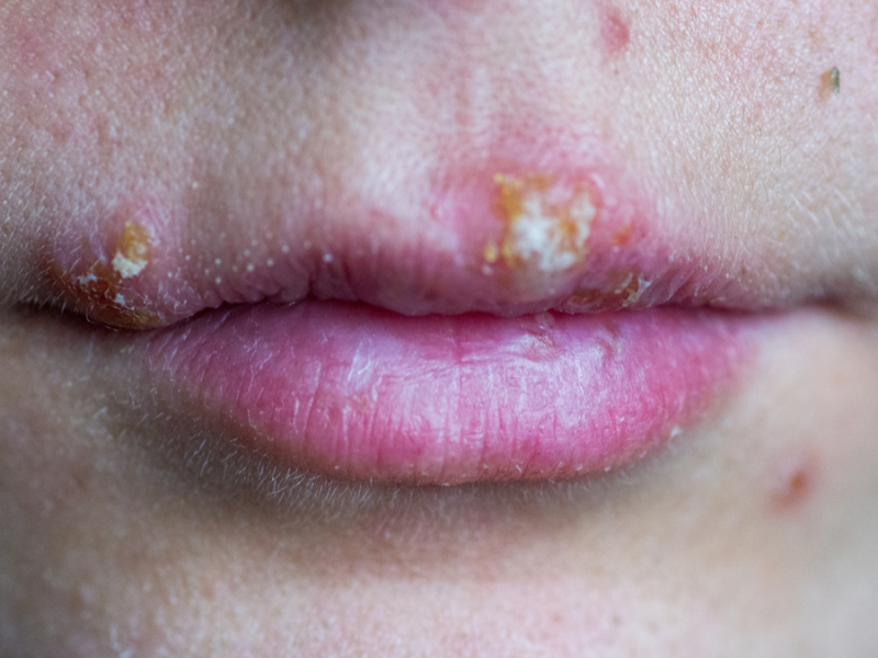 Lippenherpes Hausmittel