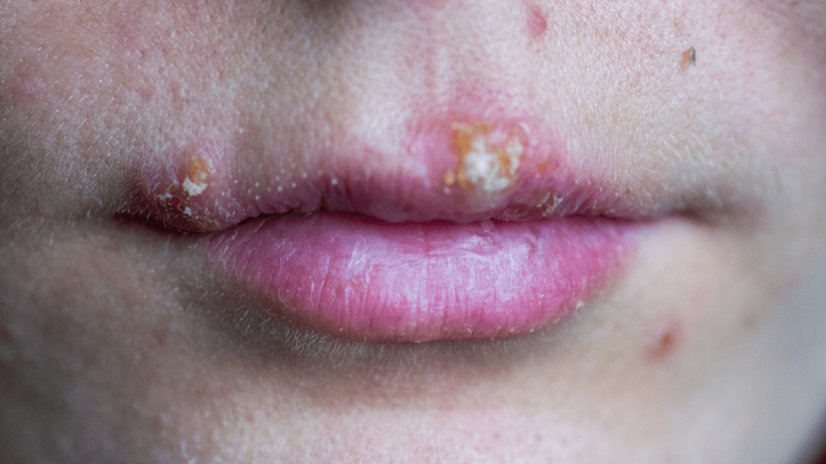 Lippenherpes Hausmittel