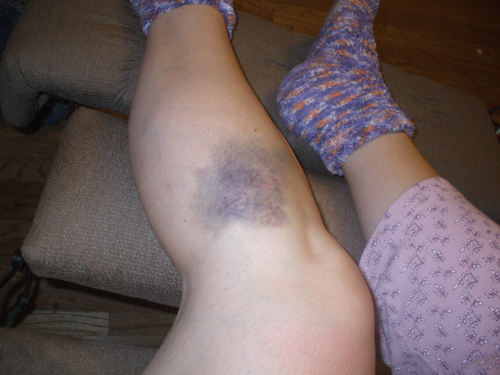 bruise