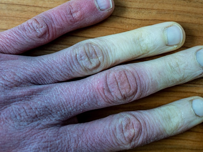 Leichenfinger: Hinter dem Phänomen steckt das Raynaud-Syndrom.