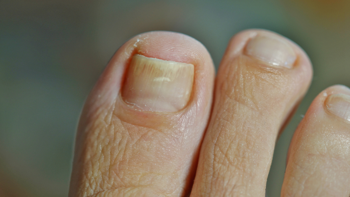 Ein Fuß, an dem man am großen Zeh Nagelpsoriasis sieht.