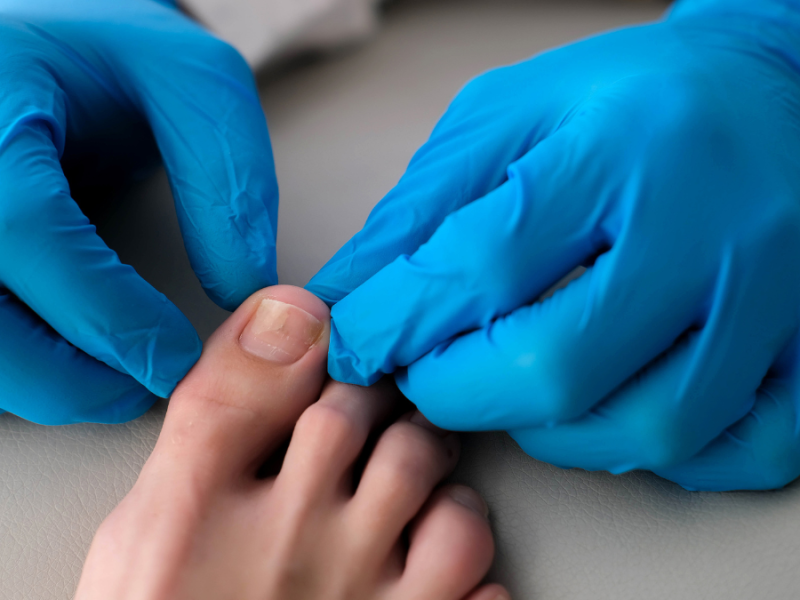 Ein Arzt mit blauen Handschuhen untersucht den großen Zeh einer Person.